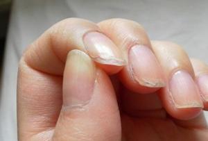 Слоятся ногти на руках – причины и лечение дефекта Слоятся ногти на правой руке причины